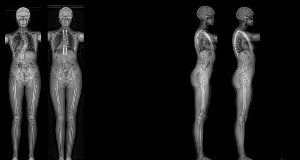 adolescent idiopathic scoliosis - pre-op and post-op