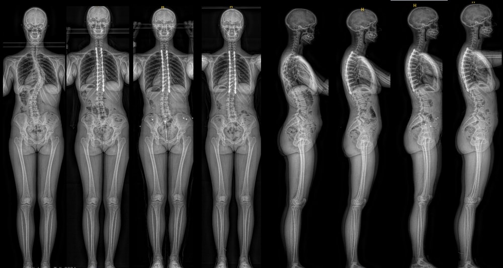 adult deformity case 1