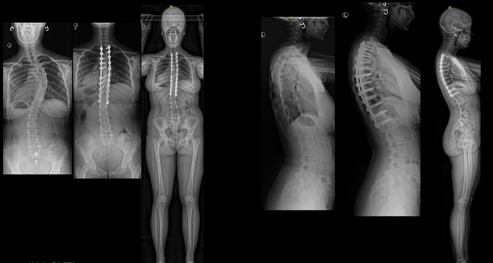 adult deformity case 2