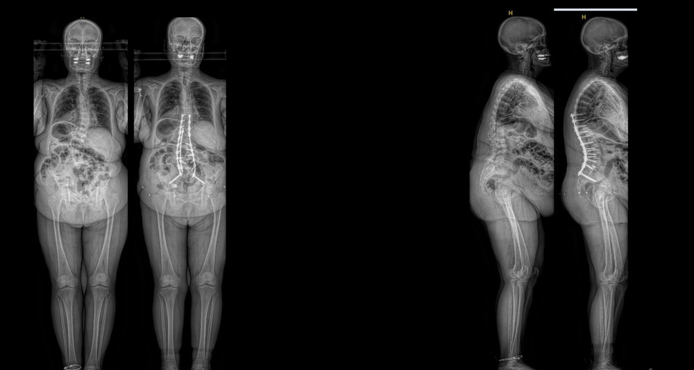 adult deformity case 3