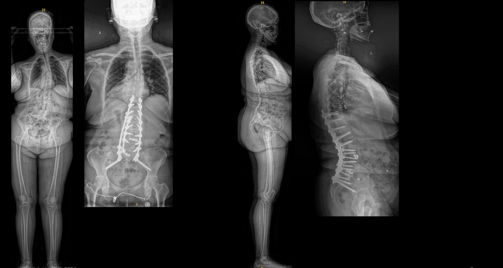 adult deformity case 4