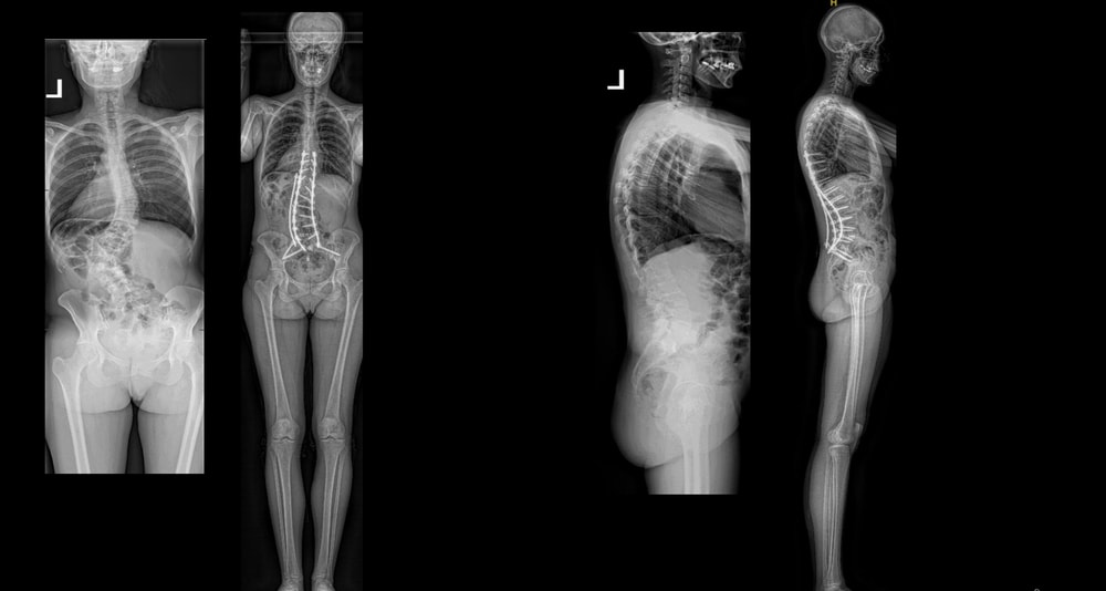 adult deformity case 5