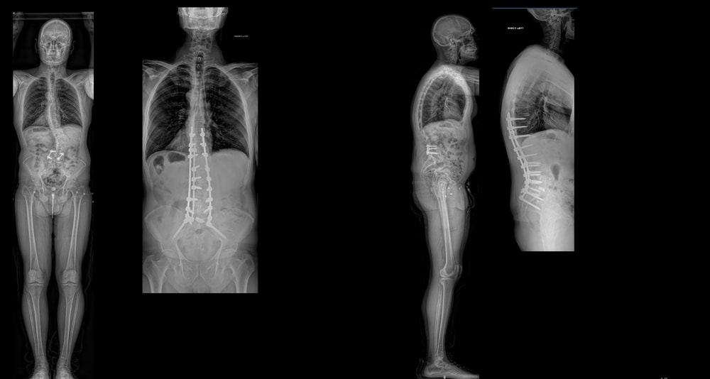 adult deformity case 6