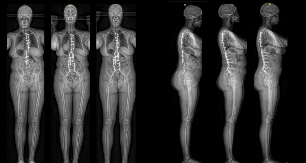 revision spine surgery - pre and post surgery