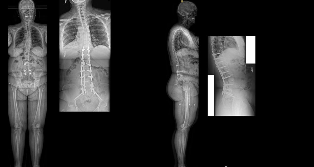 kyphoscoliosis case 1