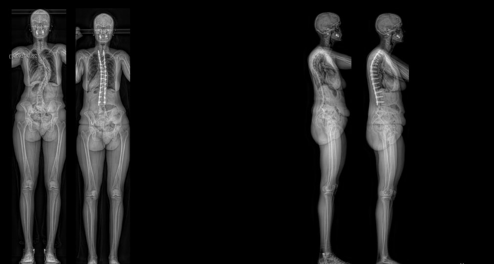 kyphoscoliosis case 2