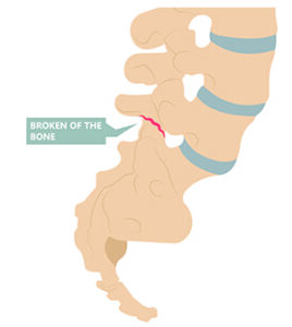 Medical Image showing spondylolysis